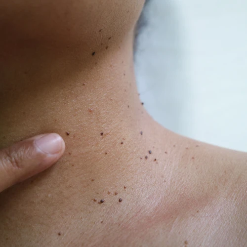 Din komplette guide til hudfliker