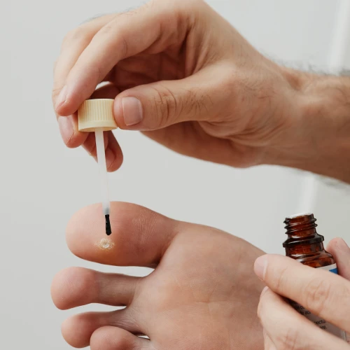 Forebygging og fjerning av vorter